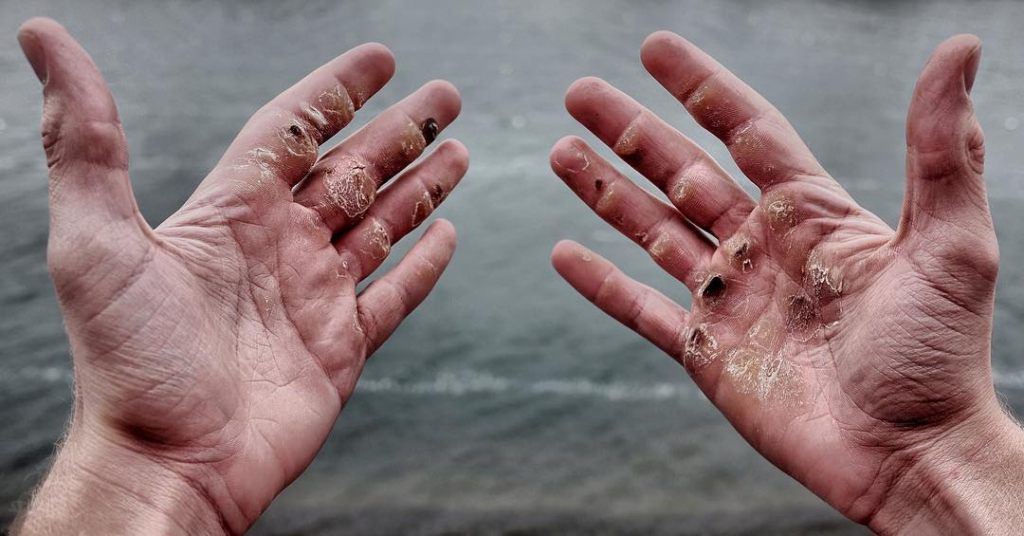 Effective Ways to Prevent and Treat Blisters and Calluses in Water Sports